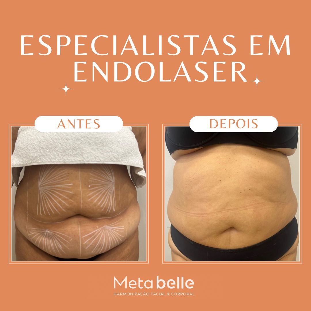 Resultados - MetaBelle Banner - Clinica de estética