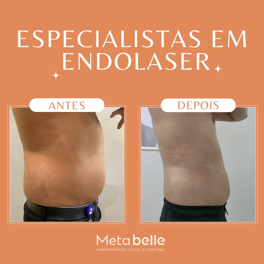 Resultados - MetaBelle Banner - Clinica de estética