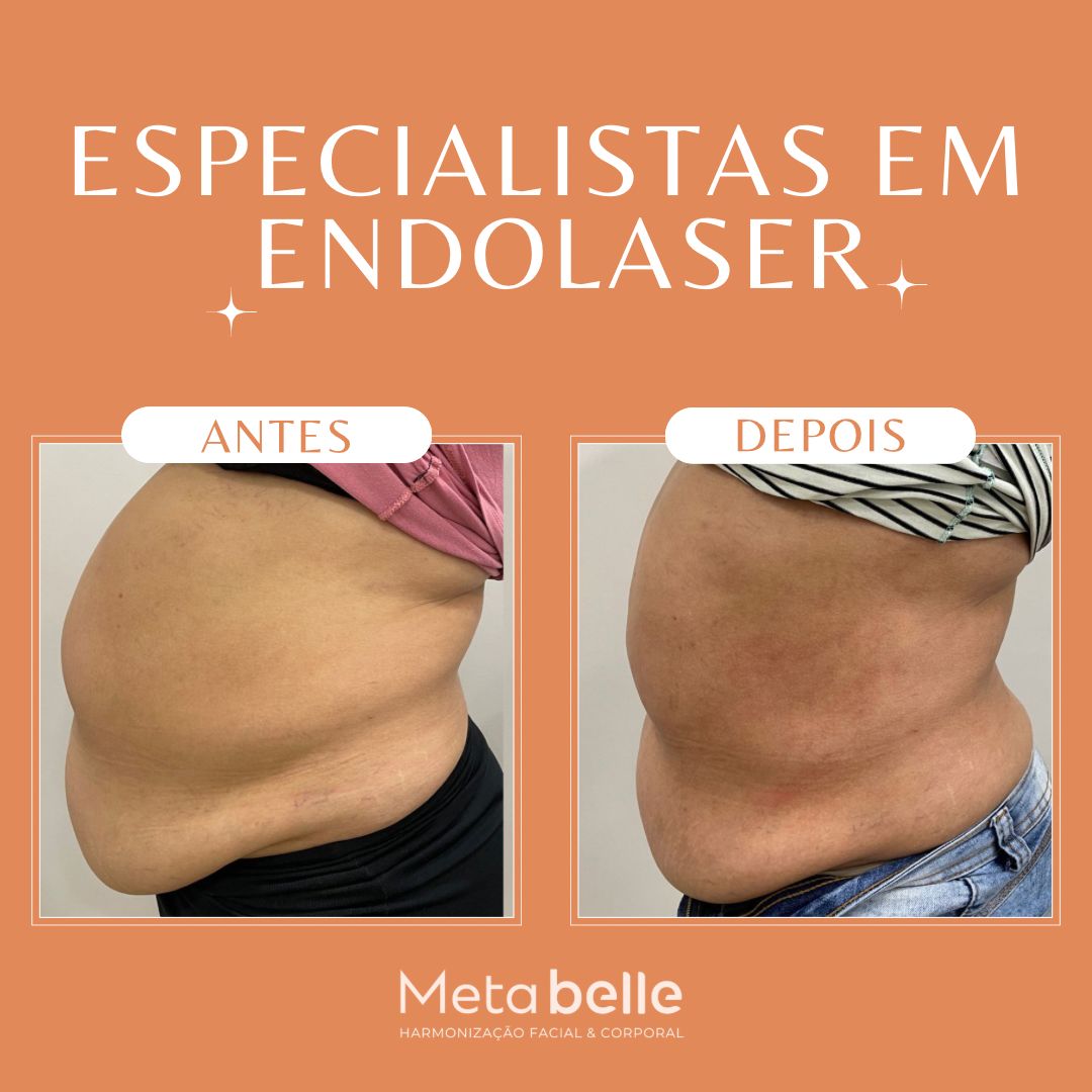 Resultados - MetaBelle Banner - Clinica de estética