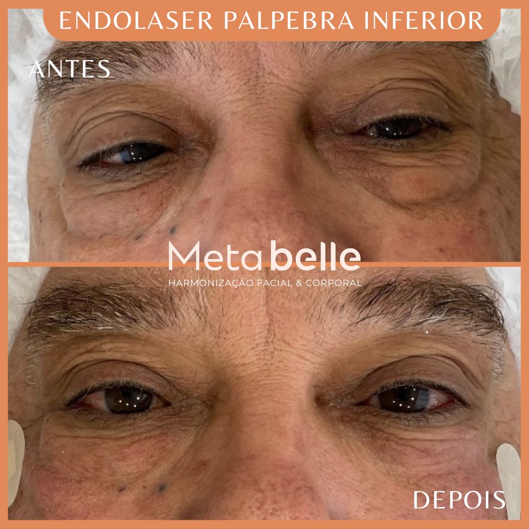 Resultados - MetaBelle Banner - Clinica de estética