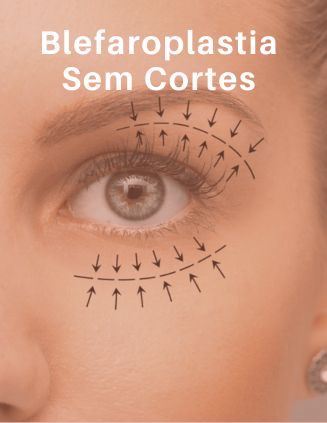 Blefaroplastia sem corte - MetaBelle - Clinica de estética
