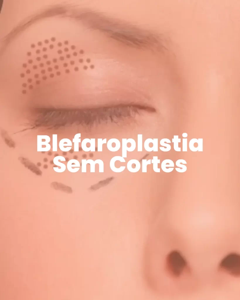 Blefaroplastia sem corte - MetaBelle - Clinica de estética