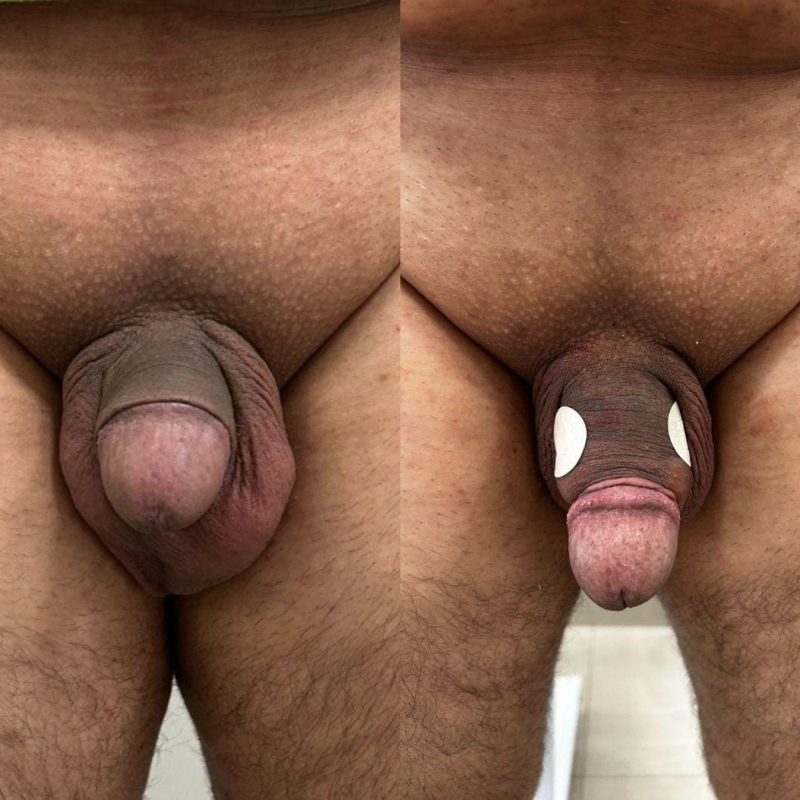 Resultado Harmonização Intima masculina - MetaBelle - Clinica de estética