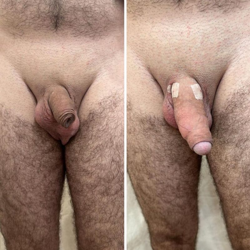 Resultado Harmonização Intima masculina - MetaBelle - Clinica de estética